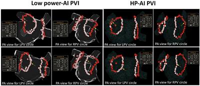 Ablation index-guided ablation with milder targets for atrial fibrillation: Comparison between high power and low power ablation